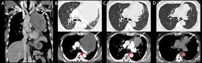 Case report: A rapid response to immunotherapy in a thoracic SMARCA4-deficient undifferentiated tumor with respiratory failure